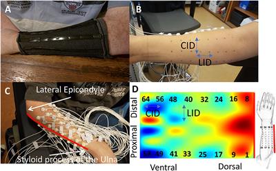 Characterization of Forearm Muscle Activation in Duchenne Muscular Dystrophy via High-Density Electromyography: A Case Study on the Implications for Myoelectric Control